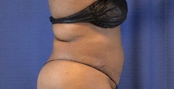 Hair transplant before & after, Patient #2