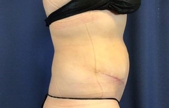 Hair transplant before & after, Patient 2