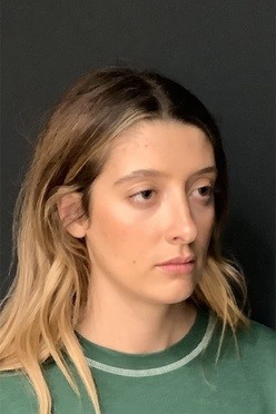 rhinoplasty patient 1 - after