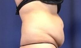 Hair transplant before & after, Patient 2