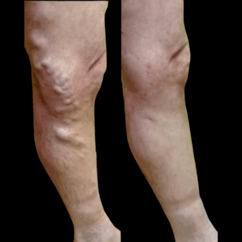 varicose vein treatment before and after