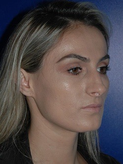 rhinoplasty patient 4 - before