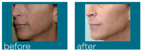 Facial fillers before and after