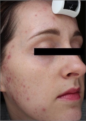 Sebacia Treatment Before