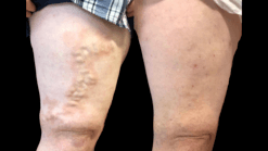 vein treatment after