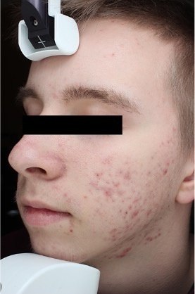 Sebacia Treatment Before