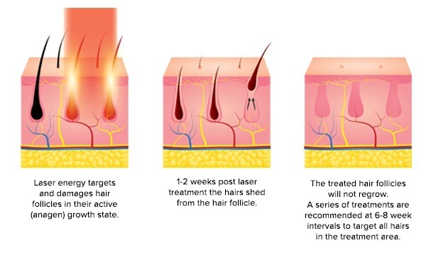 laser hair removal diagram