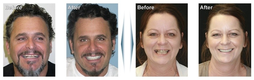 Dental Implants before and afters #1