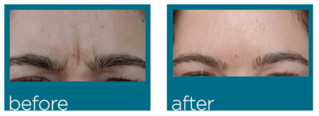 Cosmetic fillers before and after