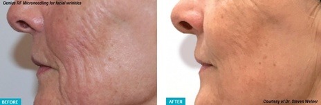 RF Microneedling before and after #1