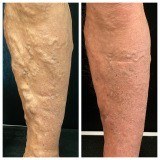 vein disease treatment before and after