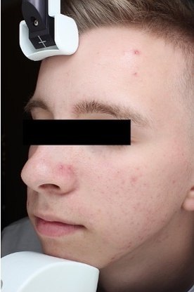 Sebacia Treatment After 4 Months