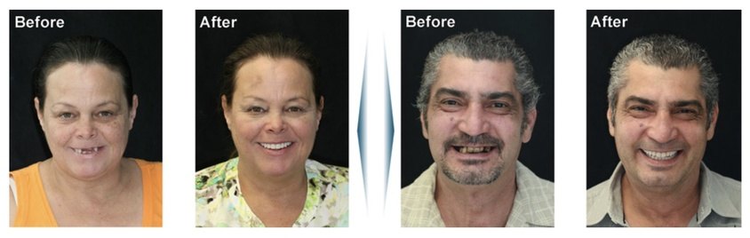 Dental Implants before and afters #2