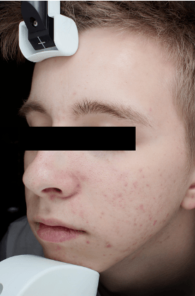 Sebacia Treatment After 2 Months