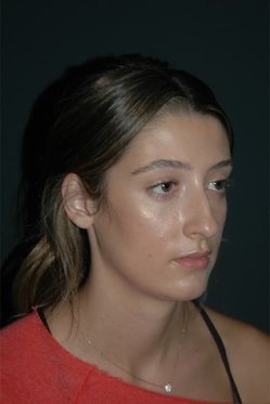 rhinoplasty patient 1 - before
