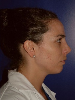 rhinoplasty patient 3 - after