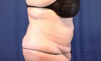 Hair transplant before & after, patient #1