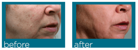 Dermal filler before and after
