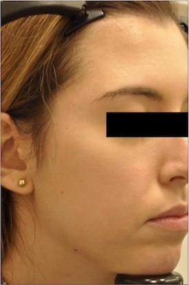 Sebacia Treatment After 6 Months