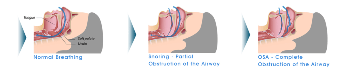 Sleep Apnea In Los Angeles
