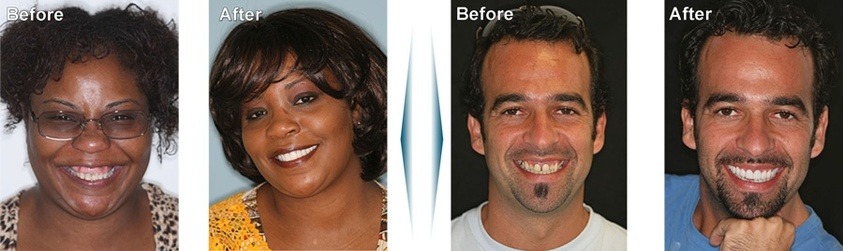 Porcelain veneers before and afters #1