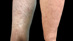 vein treatment before