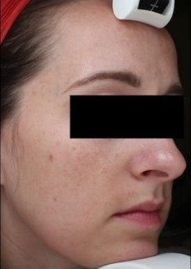 Sebacia Treatment After 4 Months