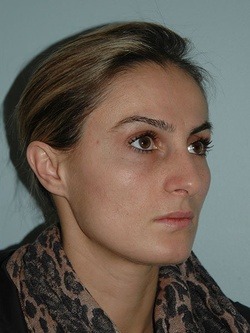 rhinoplasty patient 4 - after