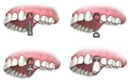 Implantes Dentários