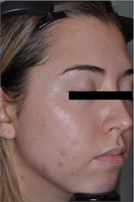 Sebacia Treatment After 4 Months