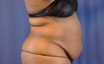 Hair transplant before & after, Patient 2