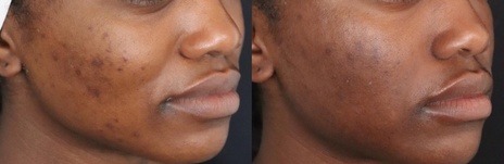 RF Microneedling before and after #2