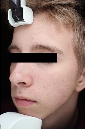 Sebacia Treatment After 6 Months