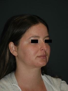 rhinoplasty patient 2 - before