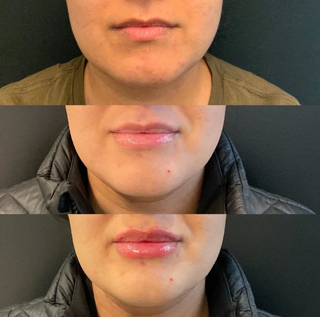 lip filler patient 5 before & after