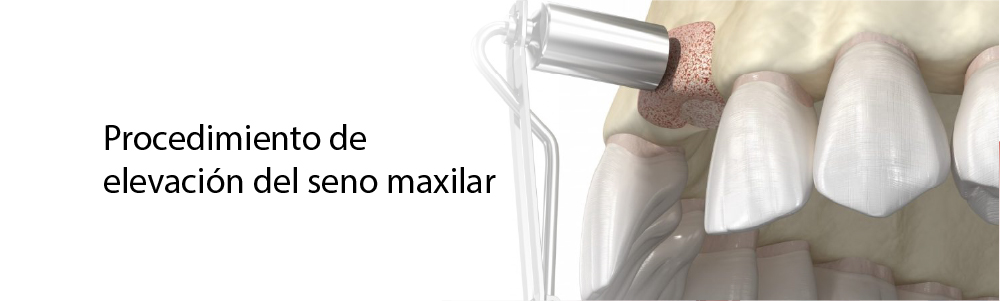 Elevación del seno maxilar