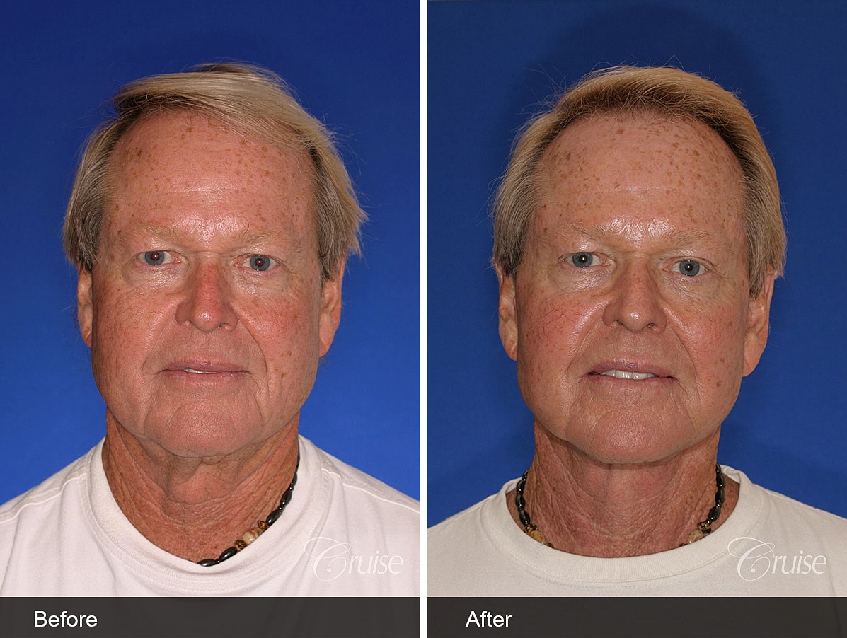facelift before and after
