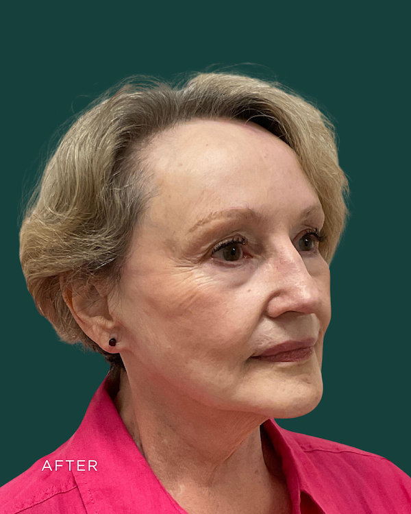 facelift before & after photo
