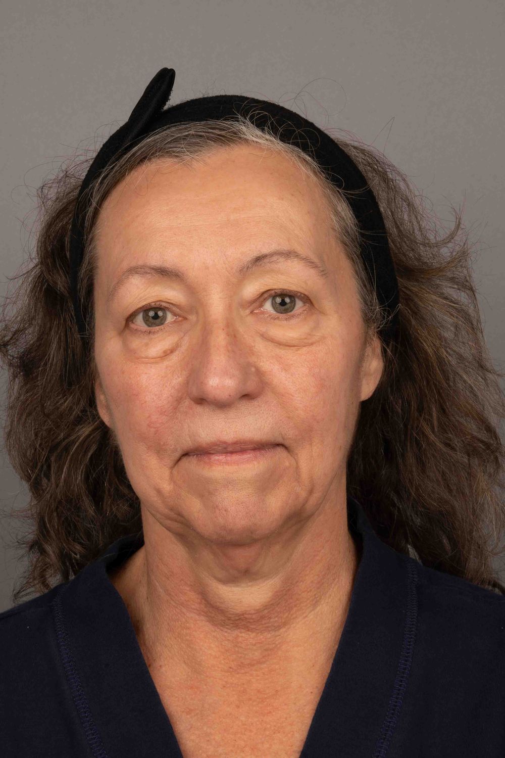 face/neck patient before & After