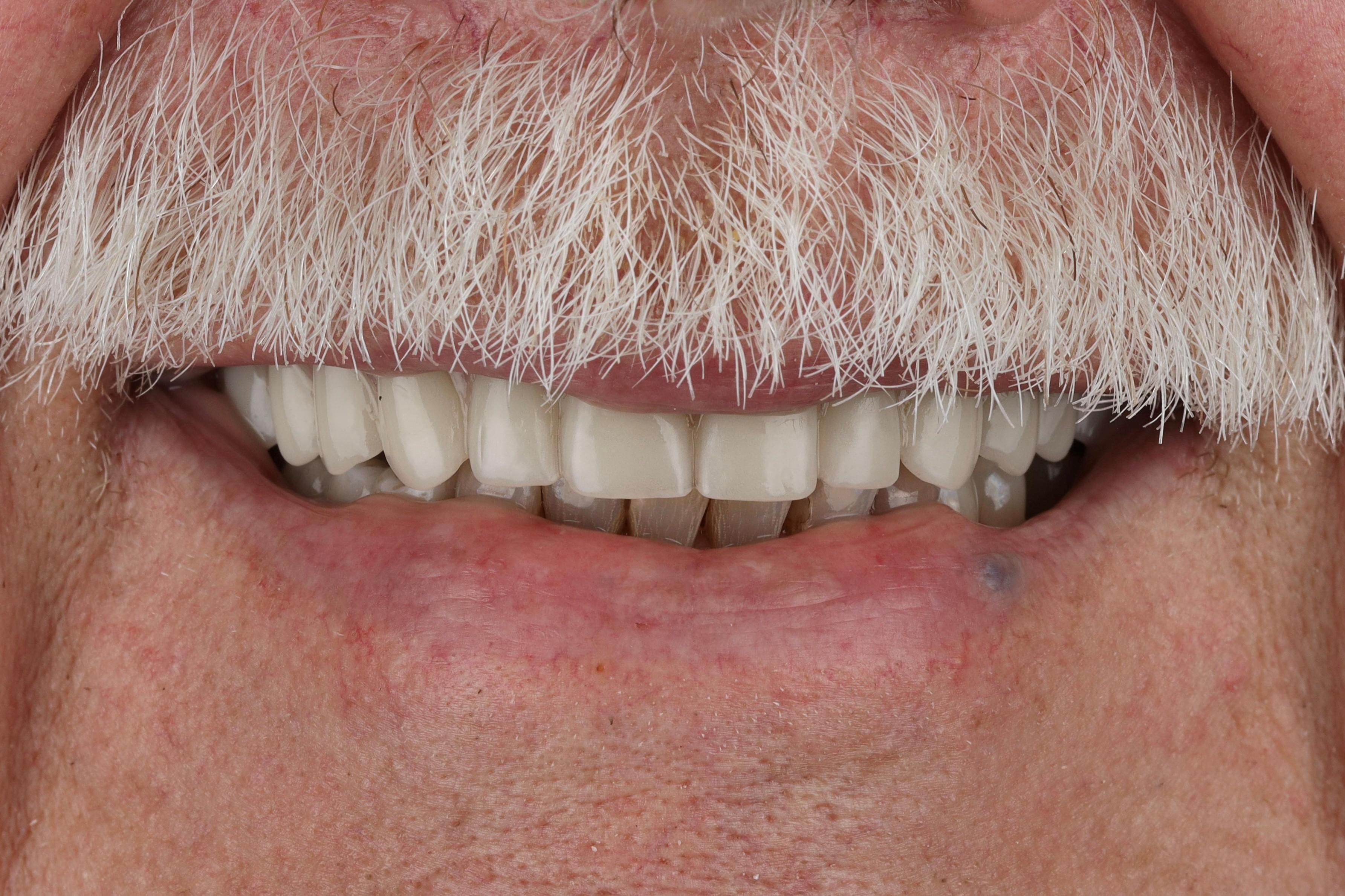 dental implants patient after