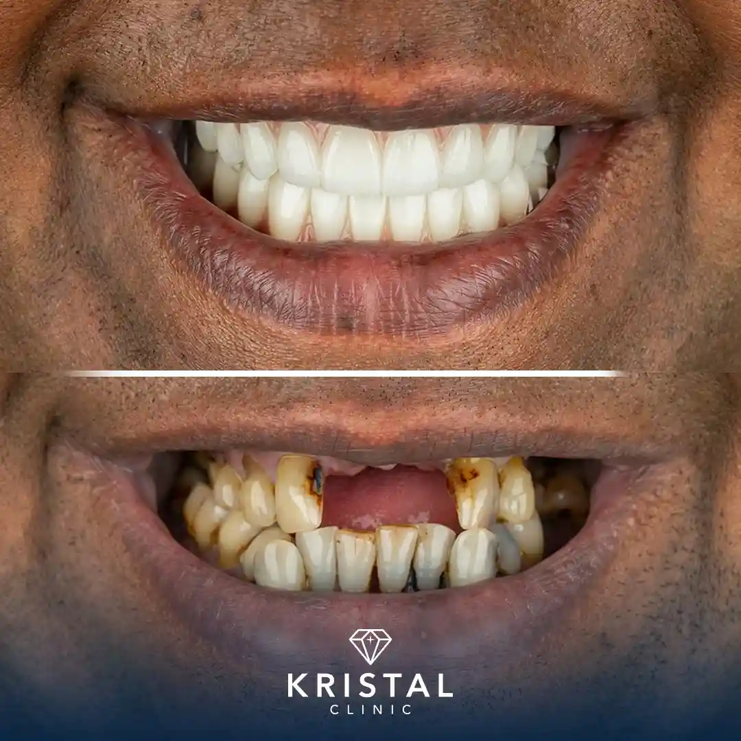 alt="Before and after dental implants transformation at Kristal Clinic"