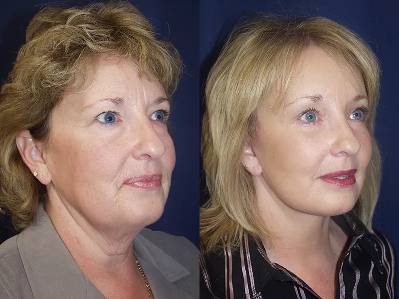 facelift and neck lift before & after