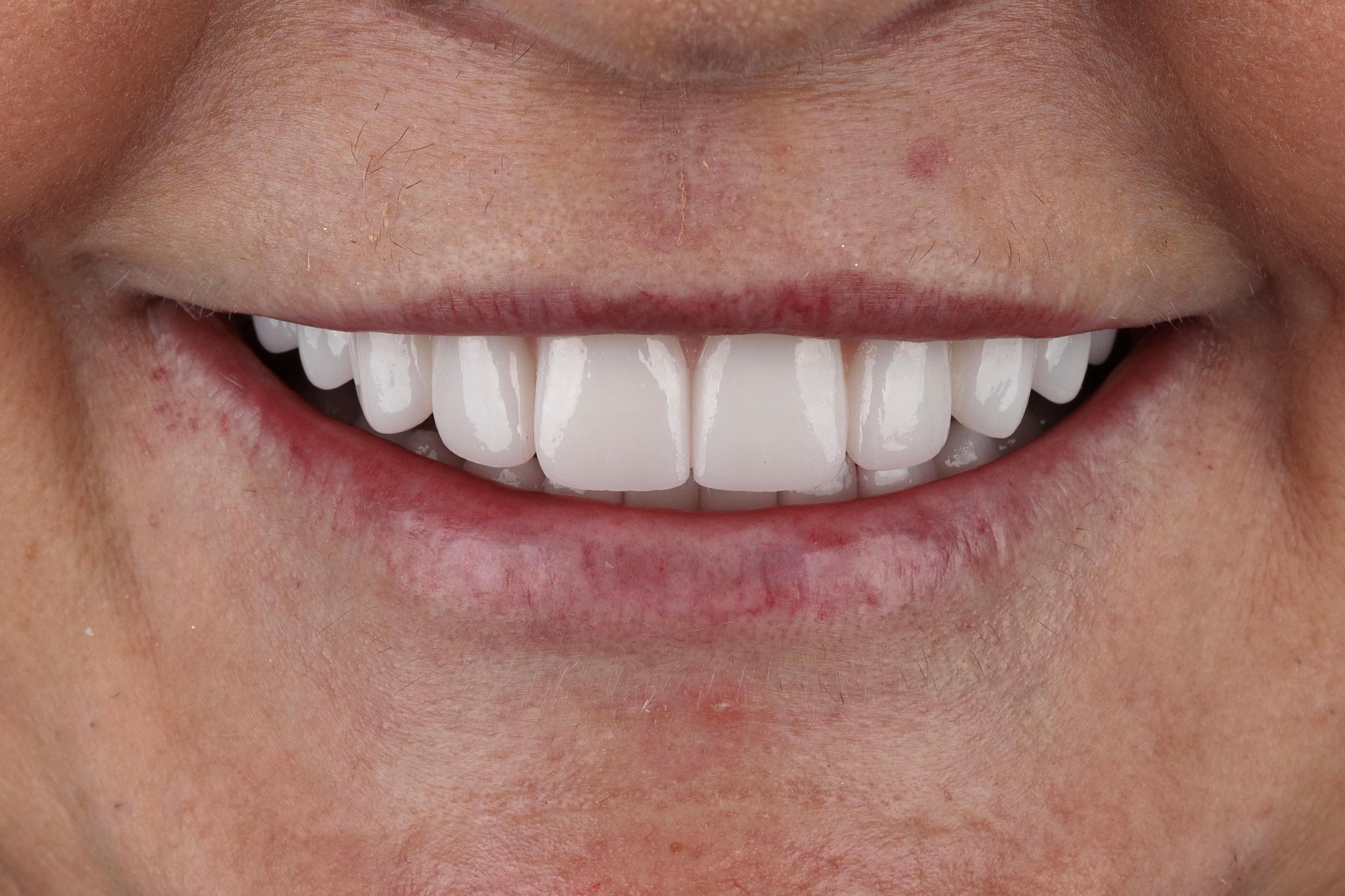 dental implants patient after