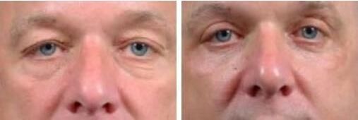 blepharoplasty patient 7 before and after