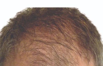 hair restoration