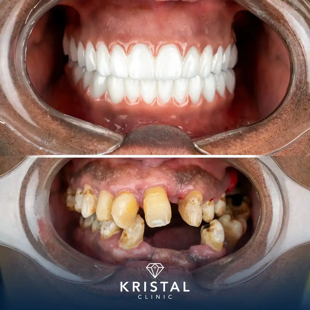 alt="Before and after dental implants transformation at Kristal Clinic"