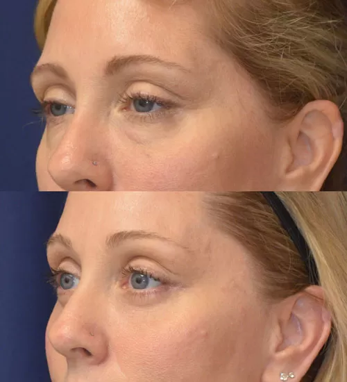 blepharoplasty before & after