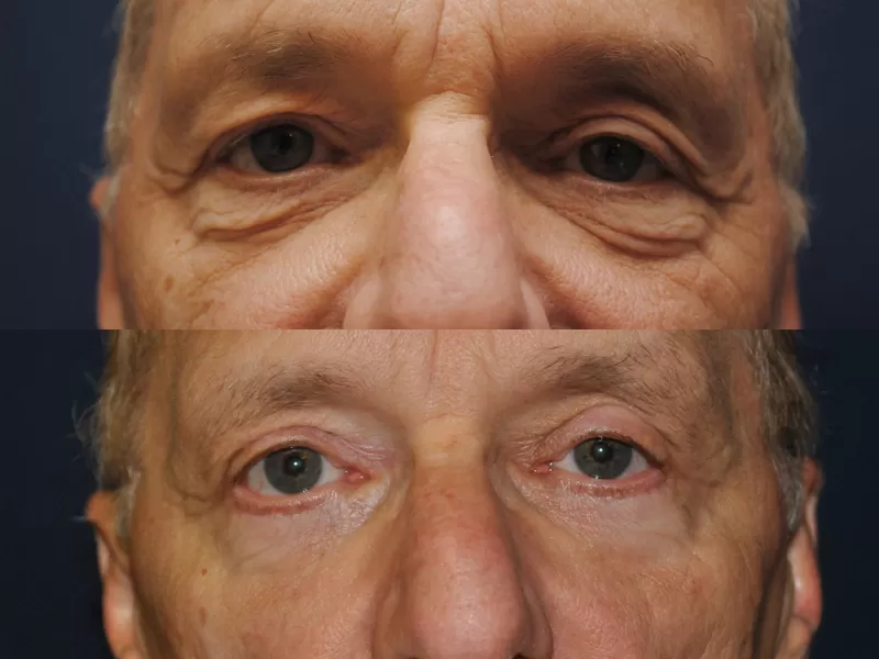 blepharoplasty before & after