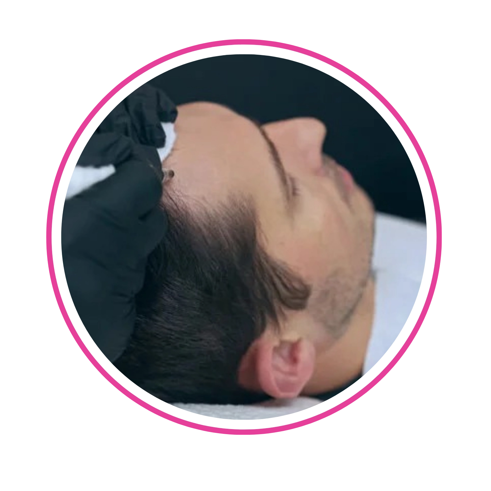 Tricopigmentation