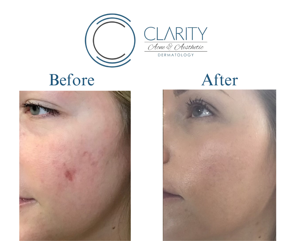 microneedling before & after
